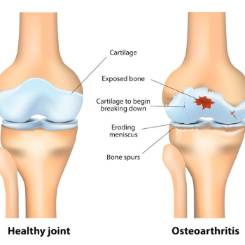 Glucosamine Chondroitin xách tay Mỹ, Ngăn ngừa viêm đau khớp