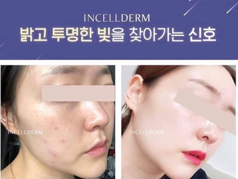 Phấn Nước dưỡng trắng da che phủ khuyết điểm Incellderm 4D lustre cushion