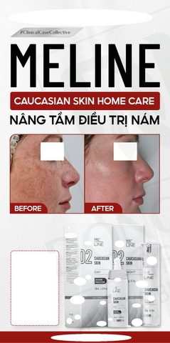 Kem đặc trị nám, phân giải sắc tố Meline 02 Caucasian Skin Night