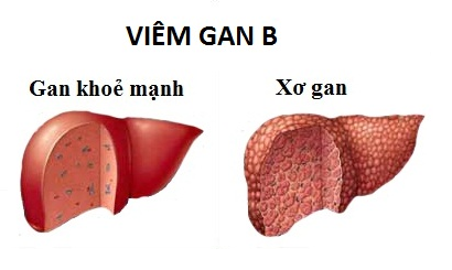 Bạn có biết về sự nguy hiểm của viêm gan B (Viêm gan siêu vi B)