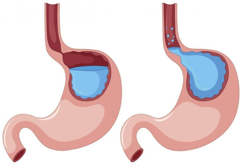 CÔNG DỤNG CỦA NƯỚC KIỀM GIÚP ĐIỀU TRỊ BỆNH TRÀO NGƯỢC DẠ DÀY (AXIT)