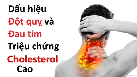 Phương pháp ngăn ngừa đột quỵ hiệu quả