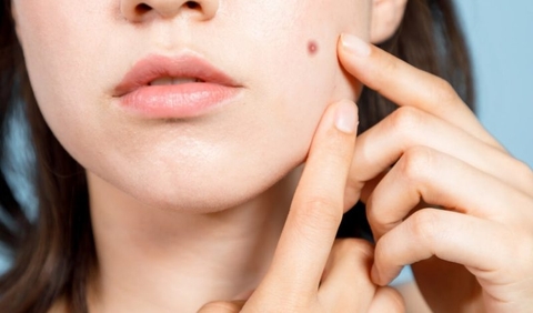 Các biện pháp khắc phục mụn trứng cá tại nhà đơn giản của Dr.Group