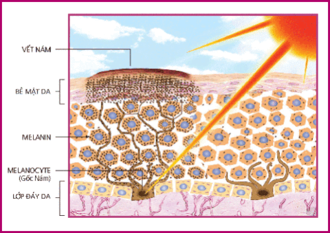 Trị nám da, sạm da, tàn nhang hiệu quả với tinh chất từ củ nghệ nguyên chất