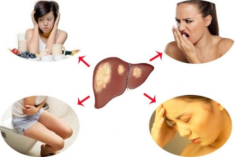 Các triệu chứng nhiễm độc gan không phải lúc nào cũng dễ xác định