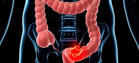 Tỷ lệ ung thư đại trực tràng ngày càng tăng ở người trẻ