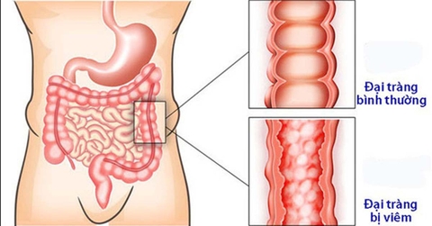 Bệnh viêm loét đại tràng và cách khắc phục tự nhiên hiệu quả