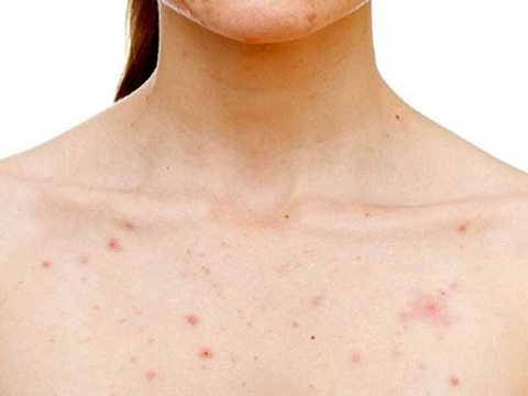 Viêm nang lông điều trị như thế nào? Tất tần tật về viêm nang lông