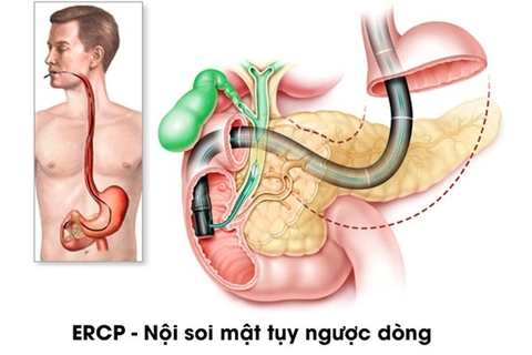 NỘI SOI MẬT TỤY NGƯỢC DÒNG ĐƯỢC DIỄN RA NHƯ THẾ NÀO?