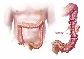 VIÊM TÚI THỪA: CHUẨN ĐOÁN VÀ ĐIỀU TRỊ.