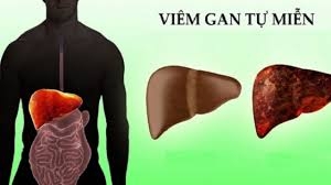 CHUẨN ĐOÁN VÀ ĐIỀU TRỊ VIÊM GAN TỰ MIỄN.