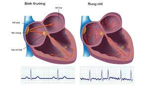 RUNG NHĨ: TRIỆU CHỨNG VÀ PHƯƠNG PHÁP ĐIỀU TRỊ NÀO HIỆU QUẢ?