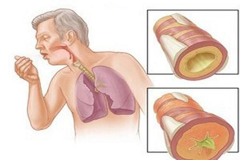 BỆNH LAO VÀ 4 TRIỆU CHỨNG KHÔNG THỂ CHỦ QUAN.