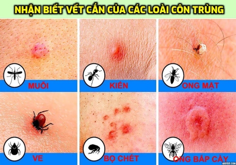 VẾT ĐỐT CỦA CÔN TRÙNG: DẤU HIỆU VÀ ĐIỀU TRỊ KHI BỊ CÔN TRÙNG ĐỐT.