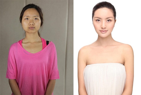 Sốc trước loạt ảnh trước và sau phẫu thuật thẩm mỹ của phụ nữ Trung Quốc