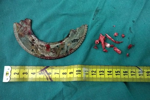 Sống sót thần kỳ dù bị lưỡi cưa cứa vào hộp sọ 2cm