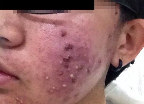 Kinh hoàng gương mặt bị nhiễm trùng do dùng mỹ phẩm qua mạng