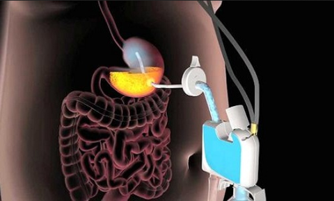 Thiết bị giảm cân bằng cách hút thức ăn trong dạ dày