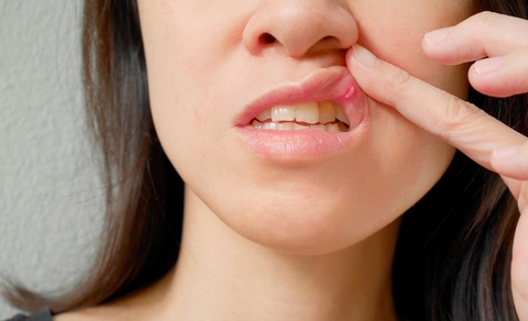 Nhiệt miệng là bệnh gì, triệu chứng, chẩn đoán và điều trị?