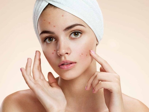 3 loại nước mát gan trị mụn mùa trong mùa hè đừng bỏ qua