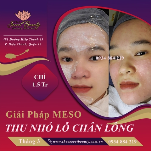 tiêm meso thu nhỏ chân lông