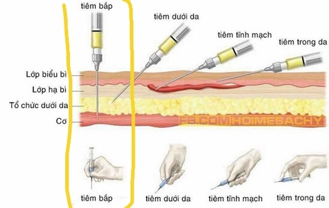 Kỹ thuật tiêm cơ bắp