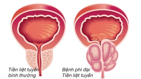 Phì Đại Tiền Liệt Tuyến Nên Ăn Gì Và Kiêng Gì Để Mau Khỏi Bệnh? Chế Độ Dinh Dưỡng Chuẩn Giúp Giảm Triệu Chứng Tự Nhiên