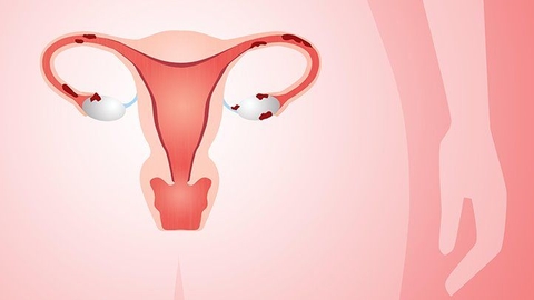 U xơ tử cung là gì? Nguyên nhân, dấu hiệu và cách điều trị hiệu quả