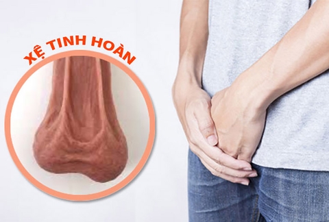 Nam Giới Bị Tinh Hoàn Xệ Có Nguy Hiểm Không? Có Dẫn Đến Vô Sinh Không?
