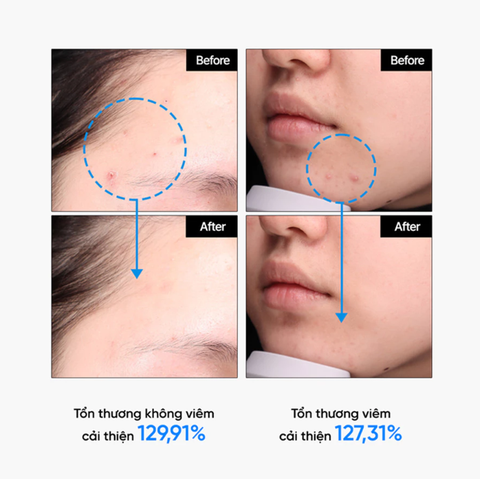 Tinh Chất Giảm Mụn Mờ Thâm Phục Hồi Da Mụn Feld Apotheke Phyto Calm Serum 30ml