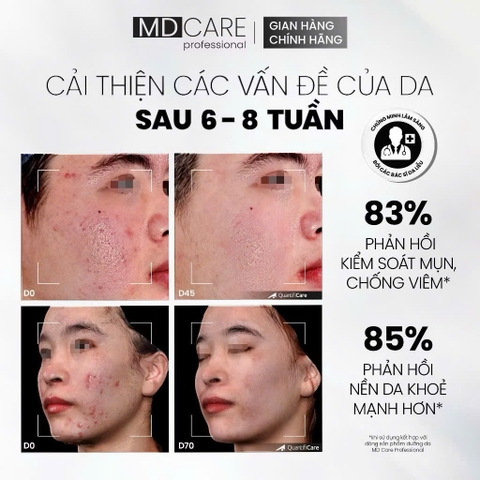 Sữa Rửa Mặt BHA Dạng Bọt MD CARE Dành Cho Da Dầu Mụn Nhạy Cảm 150ml