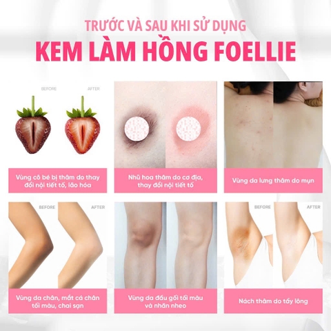 Kem Làm Hồng Nhũ Hoa Foellie, Giảm Thâm Vùng Kín Cao Cấp Hàn Quốc Foellie 30ml