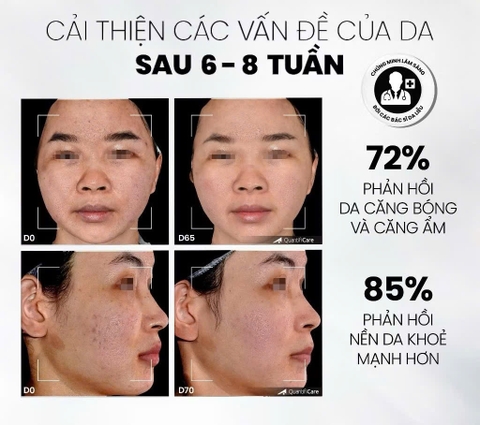 Tẩy Tế Bào Chết Home Peel Làm Sáng, Mờ Thâm Và Đều Màu Da MD Care Glow Exfo 30ml