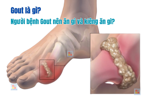 Gout là gì ? Người bệnh gout nên ăn gì và kiêng ăn gì ?