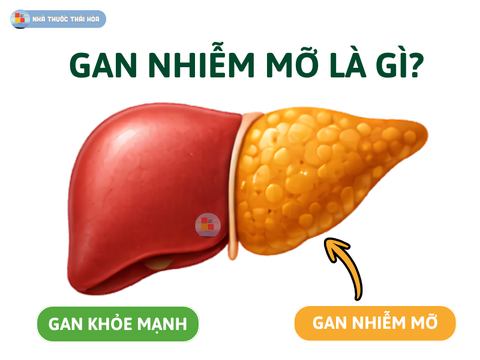 Gan Nhiễm Mỡ Là Gì? Nguyên Nhân Chính Gây Gan Nhiễm Mỡ ?