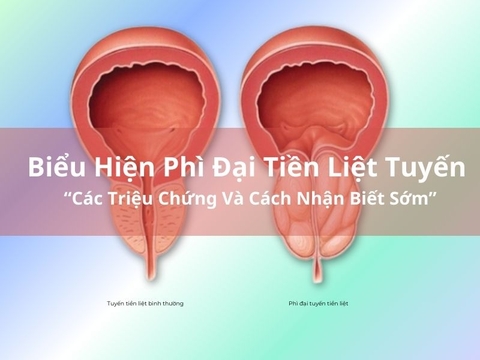 Biểu Hiện Của Phì Đại Tiền Liệt Tuyến: Các Triệu Chứng Và Cách Nhận Biết Sớm