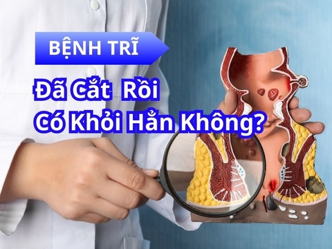 Đã Cắt Trĩ Rồi Có Khỏi Hẳn Không? Hướng Dẫn Chi Tiết từ A đến Z