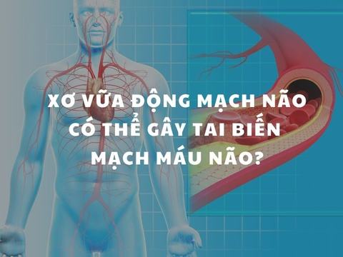 Xơ Vữa Động Mạch Não Có Thể Gây Tai Biến Mạch Máu Não?