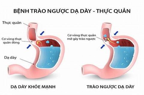 Trào ngược dạ dày thực quản và cách phòng ngừa