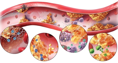 Bệnh rối loạn chuyển hóa lipid máu và cách điều trị theo y học hiện đại