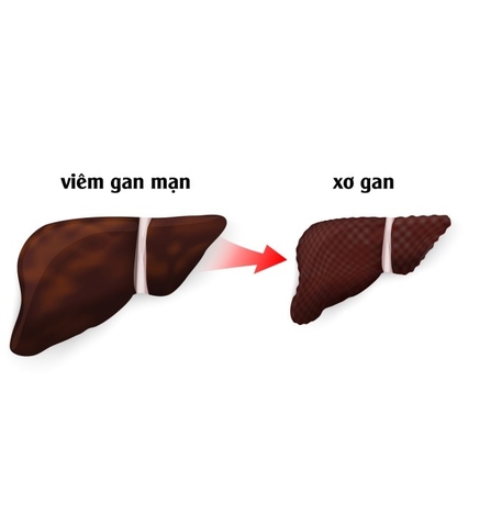 Viêm gan mạn tính và xơ gan có gì khác biệt