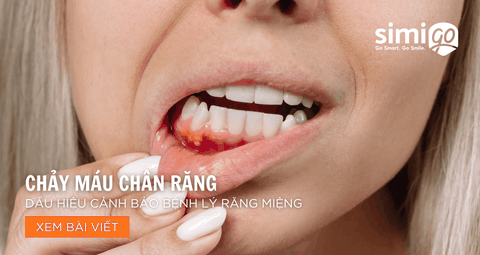 Chảy Máu Chân Răng – Dấu Hiệu Cảnh Báo Bệnh Lý Răng Miệng
