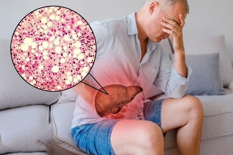 LÁ GAN CỦA BẠN CÓ KHỎE KHÔNG? HAY LÀ ĐANG SUY YẾU ?