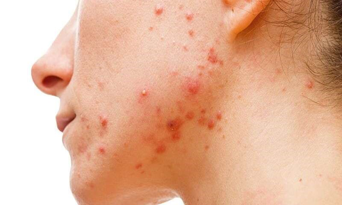 CÁC BƯỚC CHĂM SÓC DA DẦU MỤN HIỆU QUẢ TẠI NHÀ