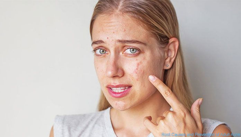 Cách chăm sóc da dầu mụn tại nhà