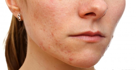 BÍ QUYẾT CHĂM SÓC DA KHÔ HIỆU QUẢ TẠI NHÀ