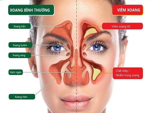 Dấu hiệu điển hình của viêm xoang