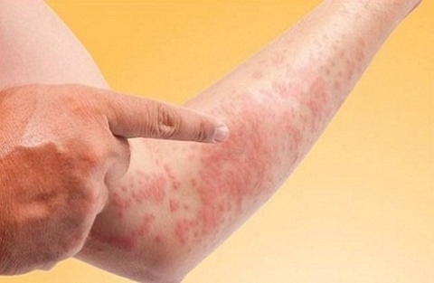 CÁC BỆNH NGOÀI DA Ở NGƯỜI LỚN THƯỜNG GẶP