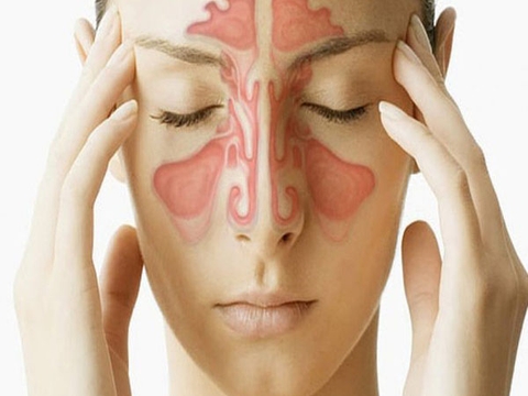 Bệnh viêm xoang là gì? Nguyên nhân, triệu chứng và cách điều trị