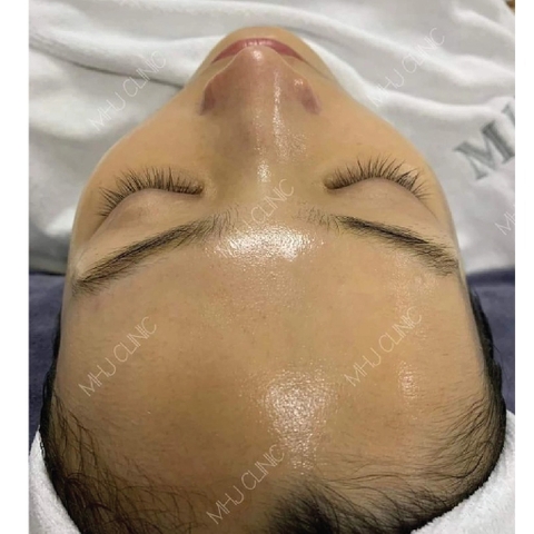 GLOW SKIN & LIFTING |  Căng bóng và nâng cơ kết hợp HIFU đầu nhỏ & Meso căng nước